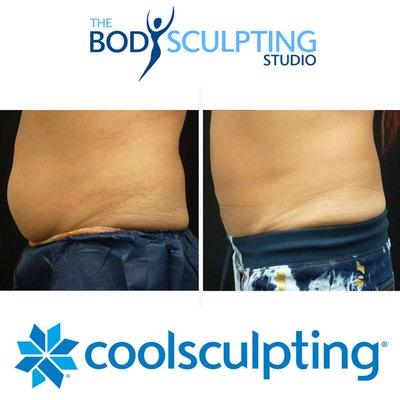 Get rid of your unwanted diet and exercise resistant fat with CoolSculpting at The Body Sculpting Studio.