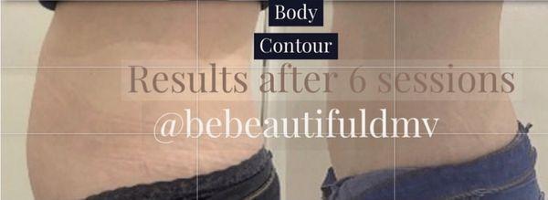 Body contouring fat reduction