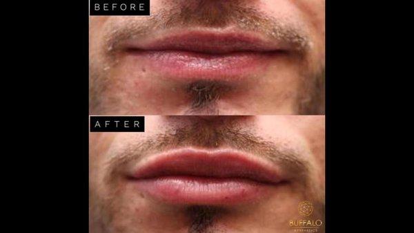 Lip Volumization with Juverderm Ultra XC