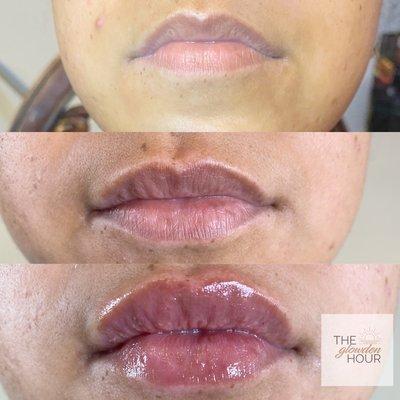 Hyaluronic Acid Lip Infusions