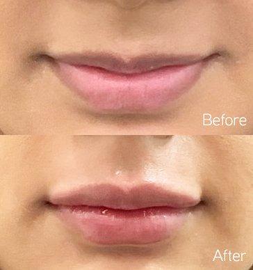 Beautiful results after lip filler. One of our client favorite procedures!