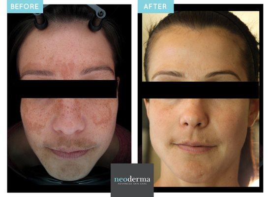 We use 3D Skin analysis technology to help track your progress (bacteria levels, wrinkles, etc) while you're undergoing treatment.