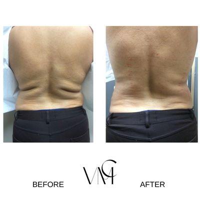 Non-surgical Laser Lipo Body Sculpt.