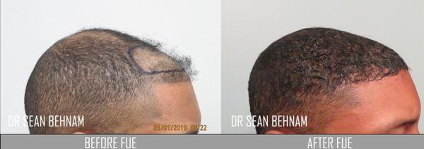 FUE hair transplant:  repair of prior poorly performed hair transplant. Notice the naturalness and density. Work performed by Dr Sean Behnam