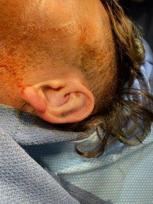 Ear reconstruction