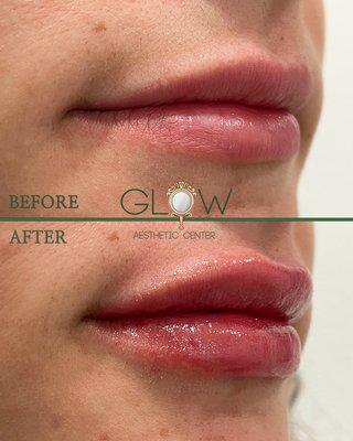 Before and after lip filler Glow Aesthetic Center