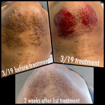 Excessive hair growth causes Ingrown hairs & skin damage. Treatment: MicroNeedling infusion