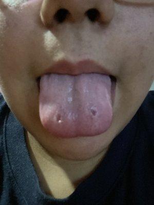 Crooked piercing and holes dig into my mouth by tiny bar that was placed in the middle of my tongue