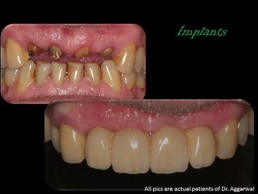 Replacing broken teeth with implants