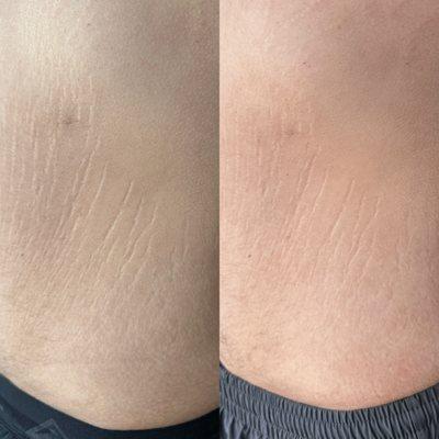 Inkless stretchmark rejuvenation treatment