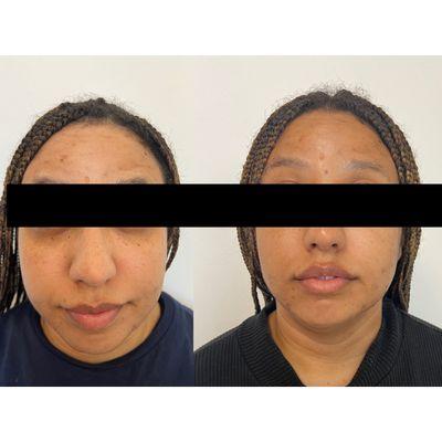 Before and after Botox brand Jeuveau and one syringe undereye filler.