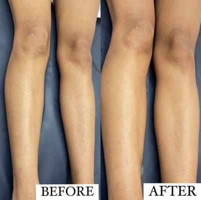 Full Leg Wax / Before+After