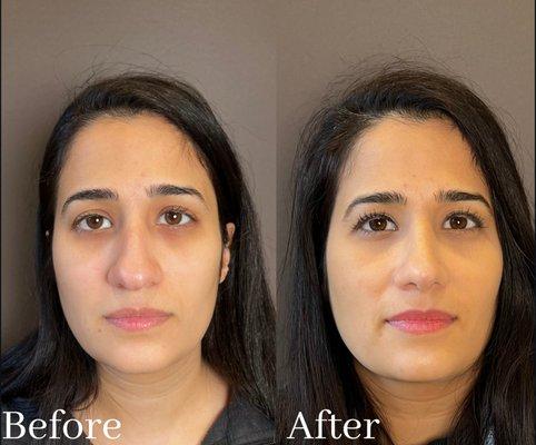 Female 3 Months  After Closed Rhinoplasty