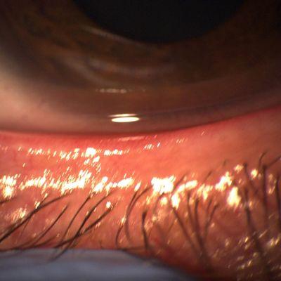 Blepharitis with Demodex infestation. Treated with Blephex and Optase Tea Tree oil gel cleaner.