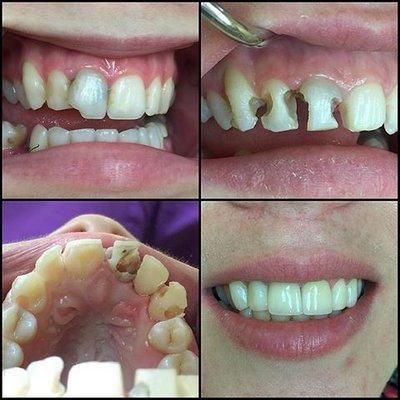 before and after pictures after the removal of decay. A conservative approach with composite material instead of porcelain crowns.