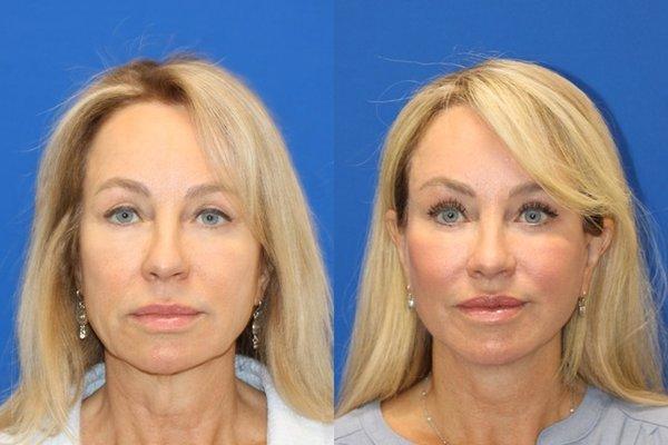 14 Months Post op. Vertical Restore, Lower Blepharoplasty, Lip Lift