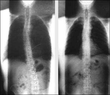 Rockville MD Chiropractic Office Before and After X-rays