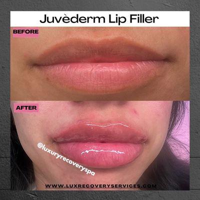 Lip filler