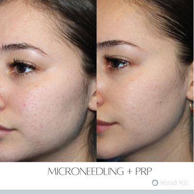 Microneedling + PRP