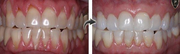 Treating Gum Recession laparoscopic, Pinhole Technique