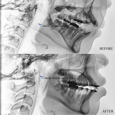 Our patient presents with severe open bite. With orthodontic treatment, her anterior open bite was eliminated in 9-12 months.