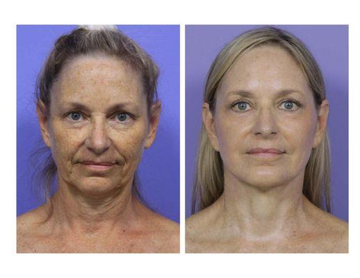 Facelift & neck lift, CO2 laser, chin augmentation and eyelid surgery by Dr. David Stoker.