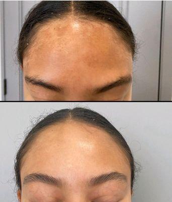 Melasma