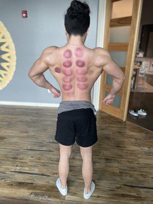 Amazing bloodflow and muscle pump after my deep tissue and cupping.