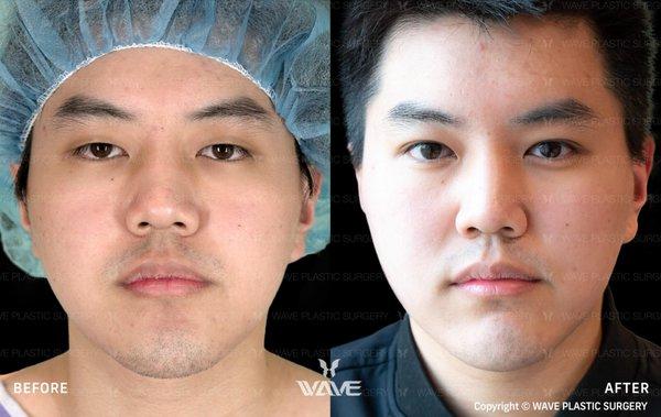 Wave Plastic Surgery & Aesthetic Laser Center Costa Mesa