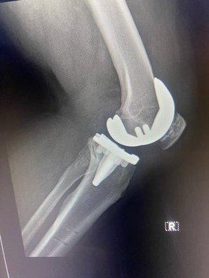 Robotic-assisted Total Knee Replacement Right knee, outpatient