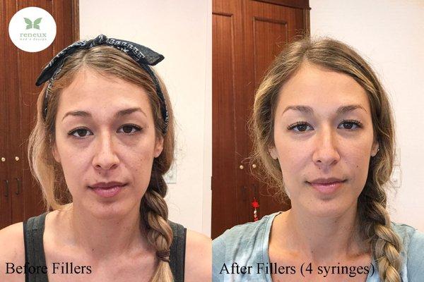 Before & After Fillers