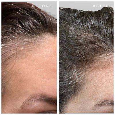 Before and after hair restoration