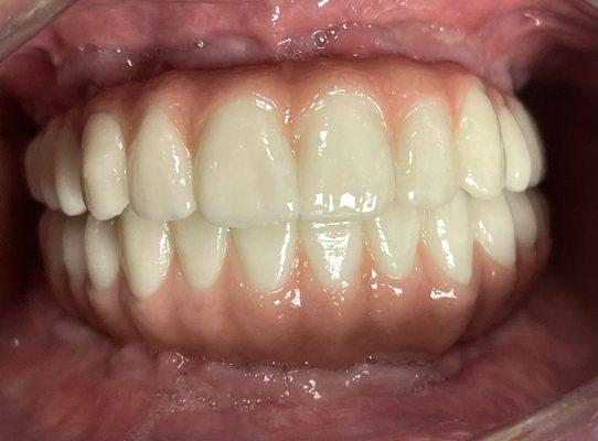 Full mouth Implant supported Zirconia Bridges