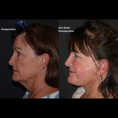 Facelift before and one week after