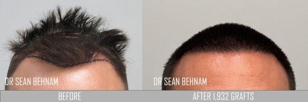 FUE hair transplant:  hairline hair transplant. Notice the naturalness and density. Work performed by Dr Sean Behnam.