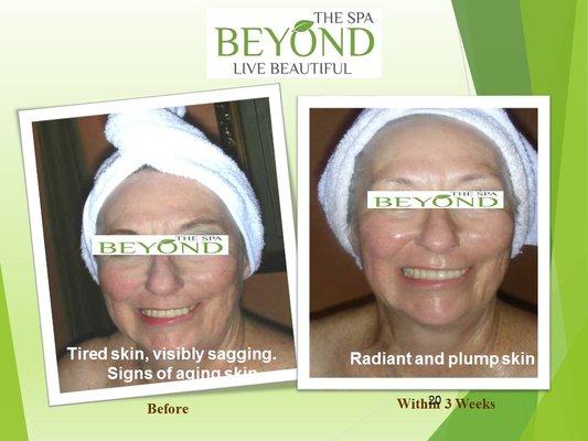 Before ~Tired skin, visibly sagging, igns of aging skin
 After ~ Radiant and plump skin