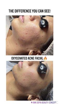 Oxygenated Acne Facial at Anso before&after