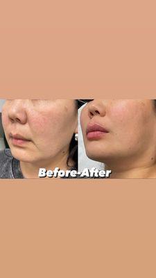 Lips and face filler