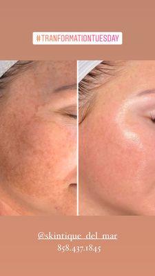 PRP microneedling & Derma peels