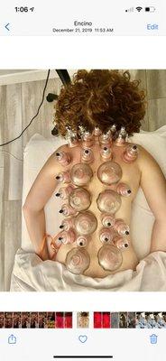 Full back cupping for the ultimate wellness and healing