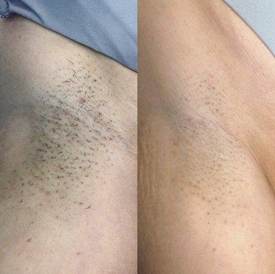 Laser hair removal after only 2 treatments!!