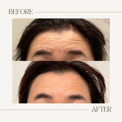 Forehead botox before and after