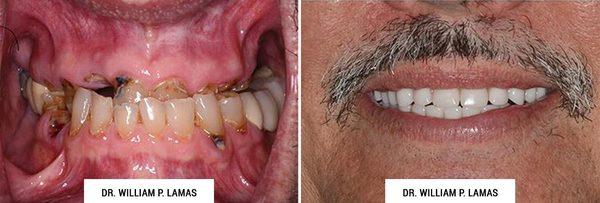 All-on-4 Dental Implants Before & After Photo - William P. Lamas, DMD - Periodontics & Dental Implants...