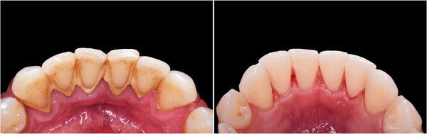 Teeth Cleaning, before and after