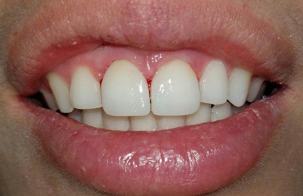 After picture of anterior veneers,  which were done in the same day with cerec machine.