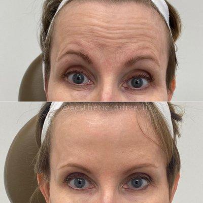 Botox results by aesthetic nurse Liz! Liz has 10+ years experience injecting and focuses on producing natural results.