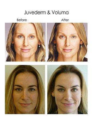 JUVEDERM AND VOLUMA