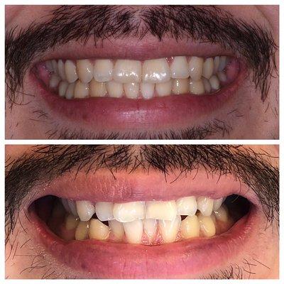 Invisalign and bonding on two front teeth