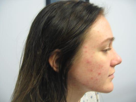 Acne: before