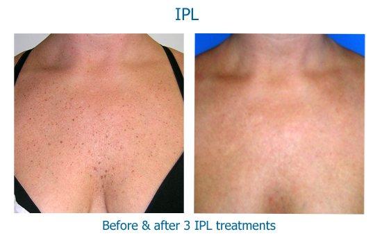 Our patient before & after spot removal